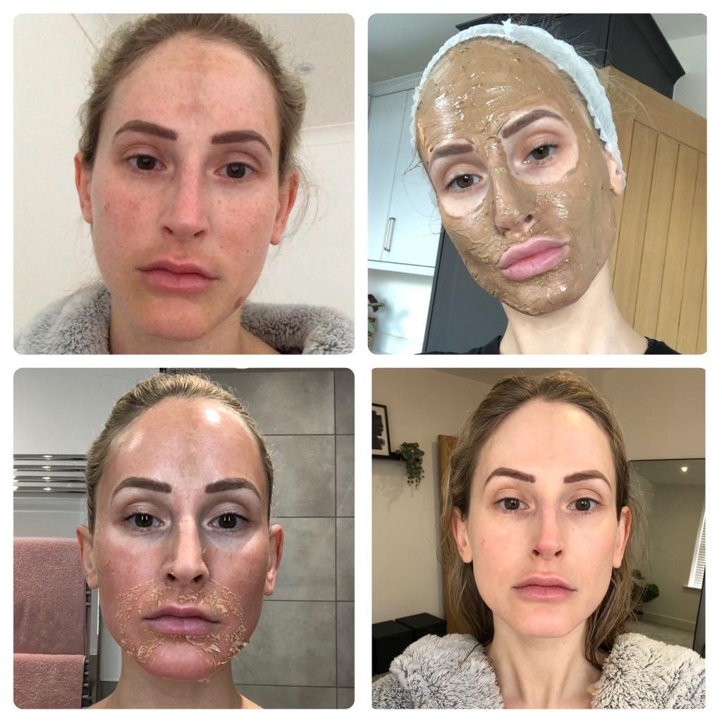 Cosmelan Peel Treatment