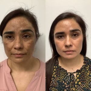 Cosmelan Peel in New Orleans - Regenesis Medical Spa & Laser Skin Clinic
