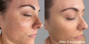 6n3bukCcGbVh-12-Pico-Laser-Carbon-PeerlAcne-and-Scars-Treatment-before-after-1-1