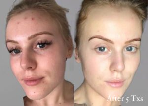 Glycolic Acid Peel