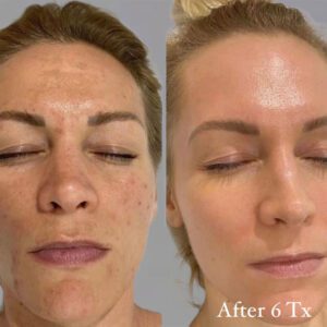 eW3mS4PN5SvU-3-Glycolic-Chemical-Peel.-IMG-_4231jpeg