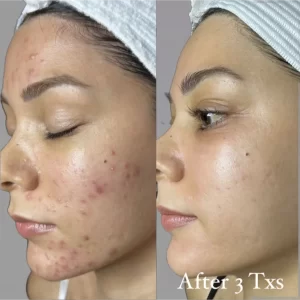 z5ZRGG6kz8lZ-2-Glycolic-Acid-Peel-IMG_-5934peg