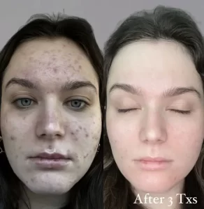 Salicylic Peel