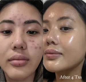 Salicylic Peel