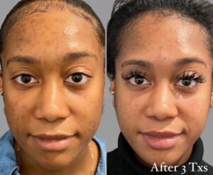 Copy of Facelifts - Before and After