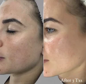 Salicylic Peel