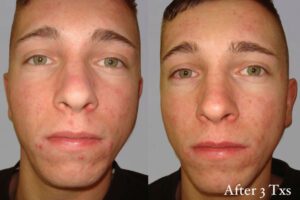 Salicylic Peel